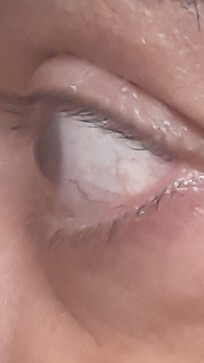 left eye in the morning upon awaking, after 10 hours of sleep & systane gel drops at nite