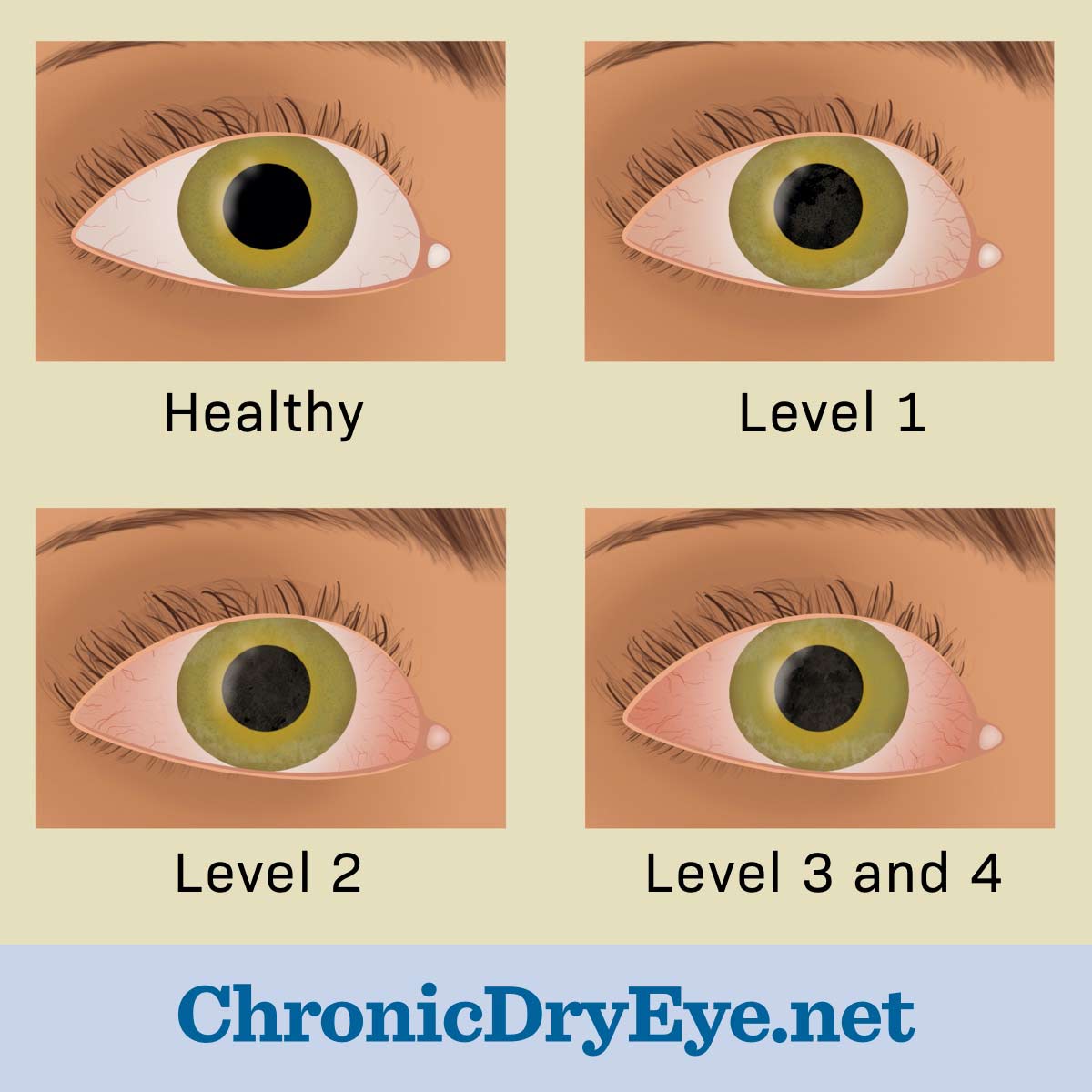 What chronic dry eye looks like