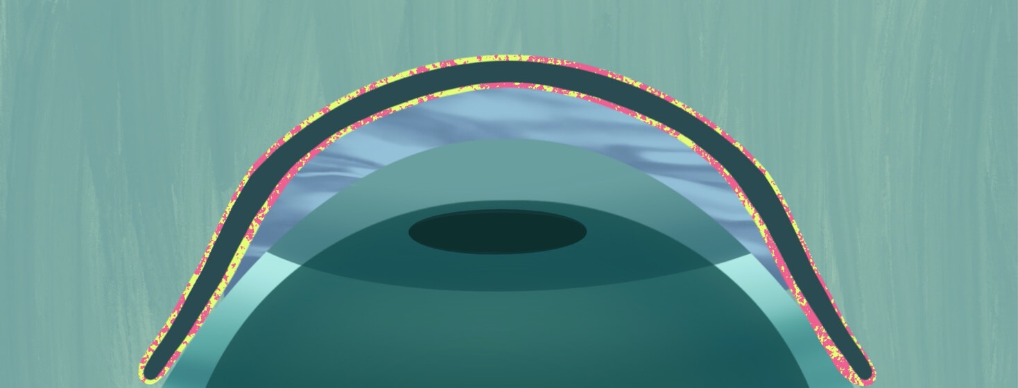 Anatomical drawing of a scleral lens on an eye, with the scleral lens stylistically highlighted.